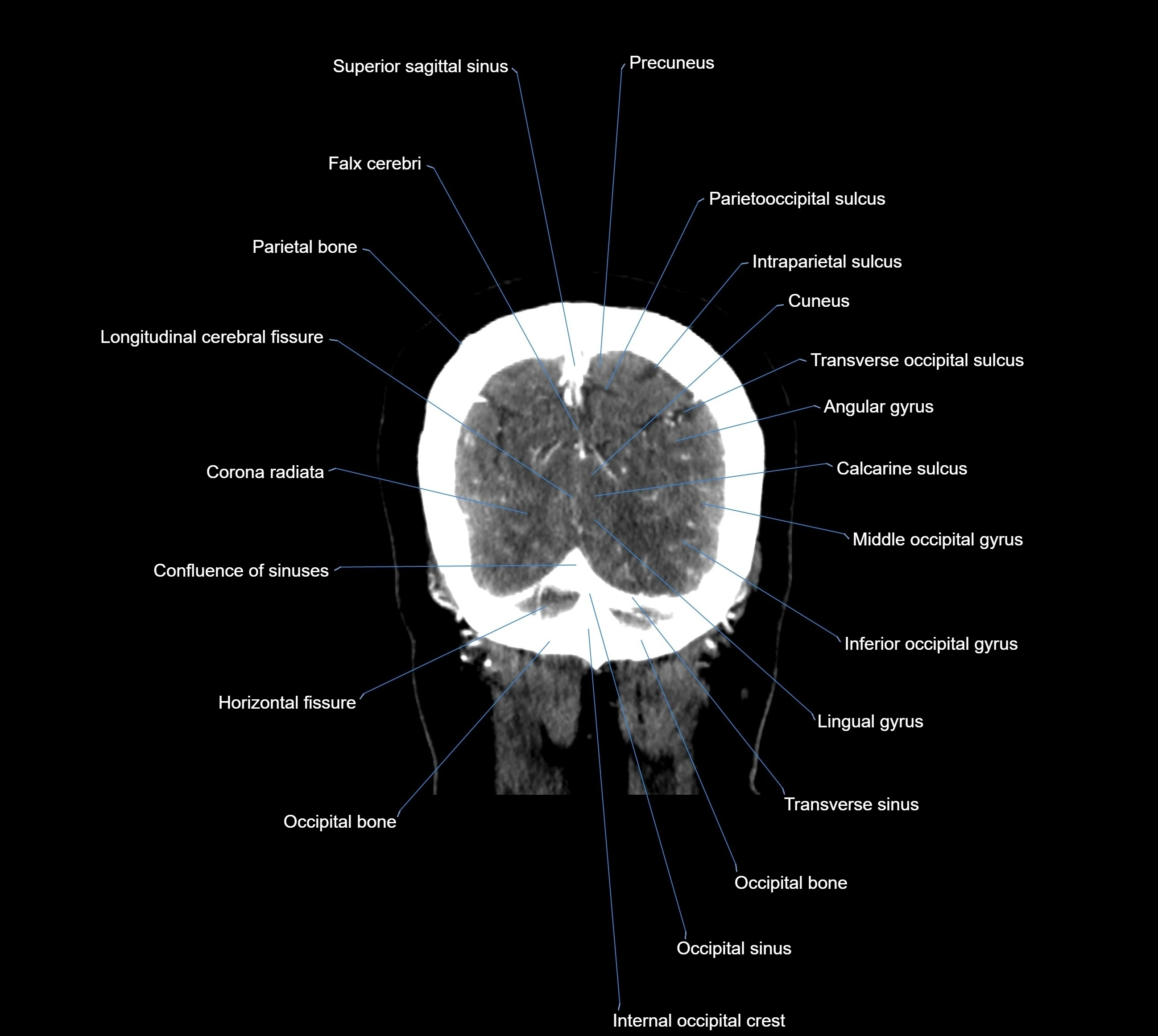 CT Brain coronal cross sectional radiology anatomy image  -img-00001-041.webp
